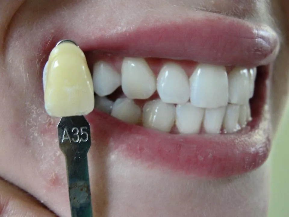 Patient smile result