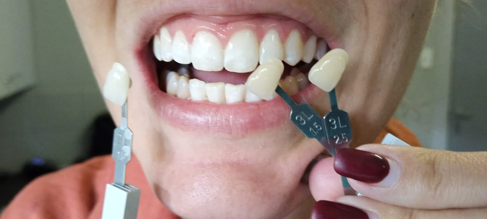 Teeth whitening before and after result