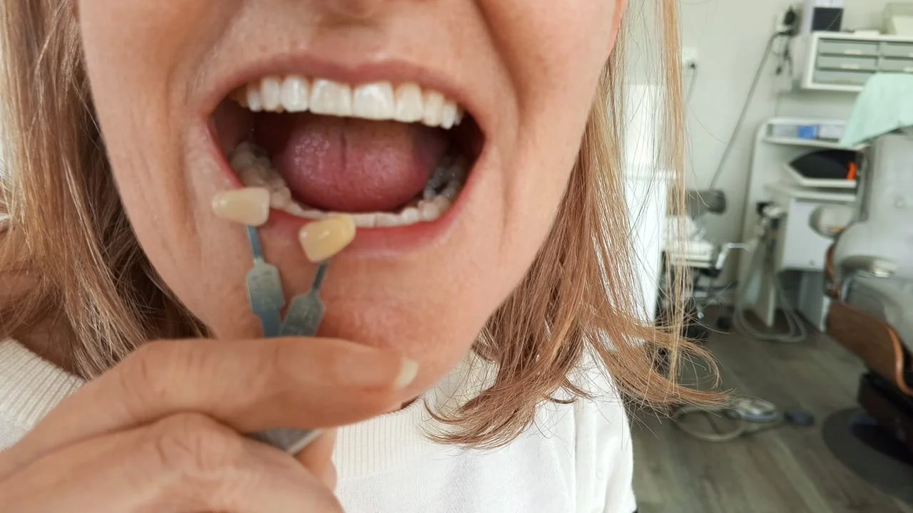 Teeth whitening before and after result