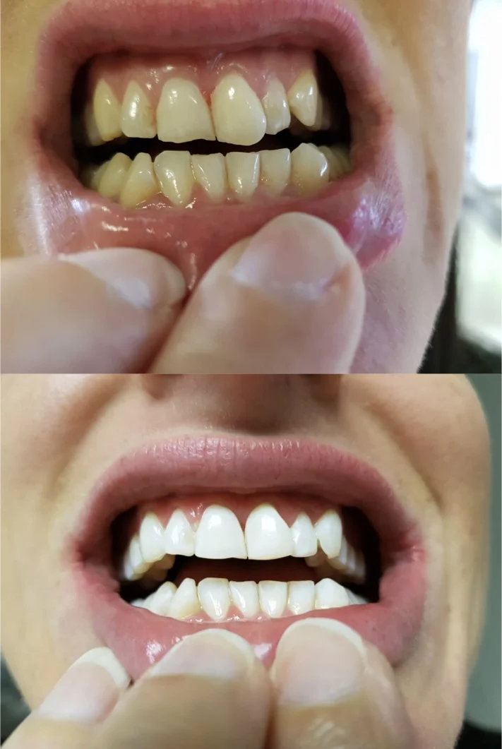 Teeth whitening before and after result