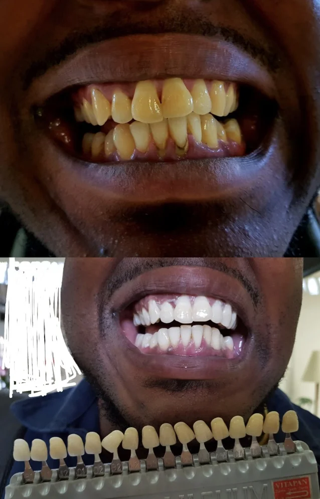 Teeth whitening before and after result