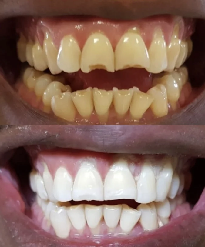 Teeth whitening treatment