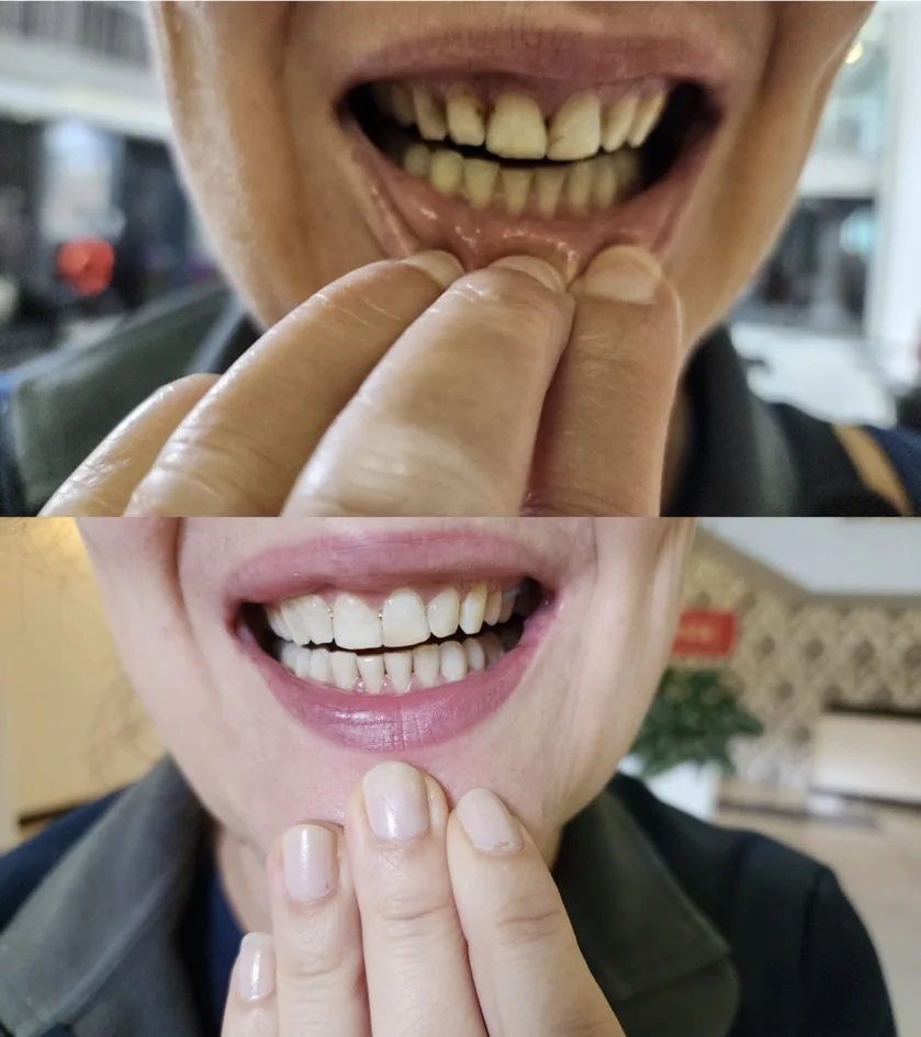 Teeth whitening before and after result