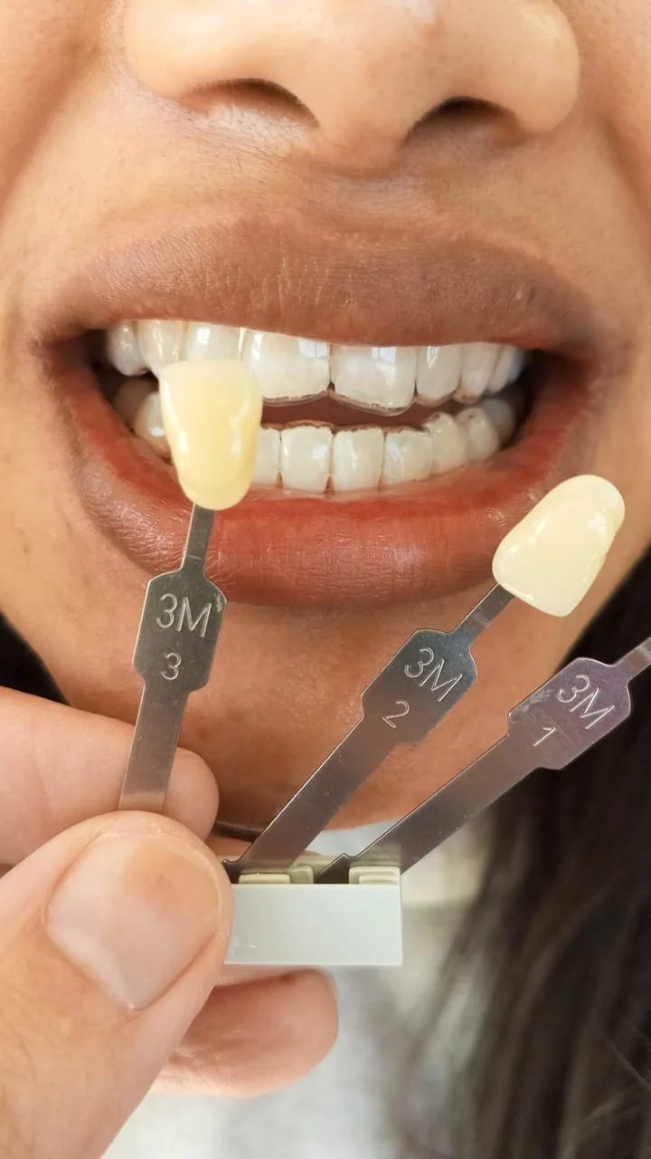 Teeth whitening result