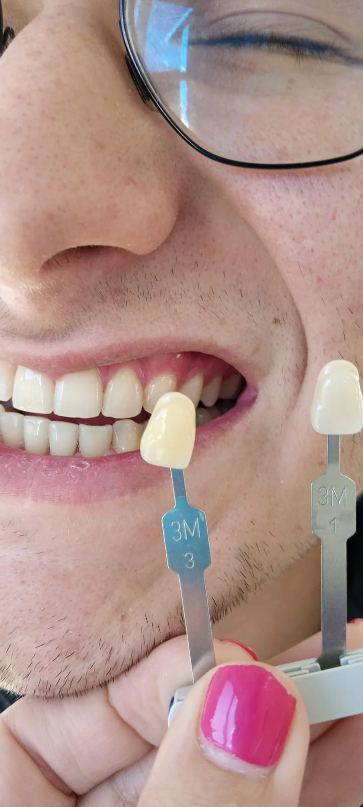 Teeth whitening before and after result