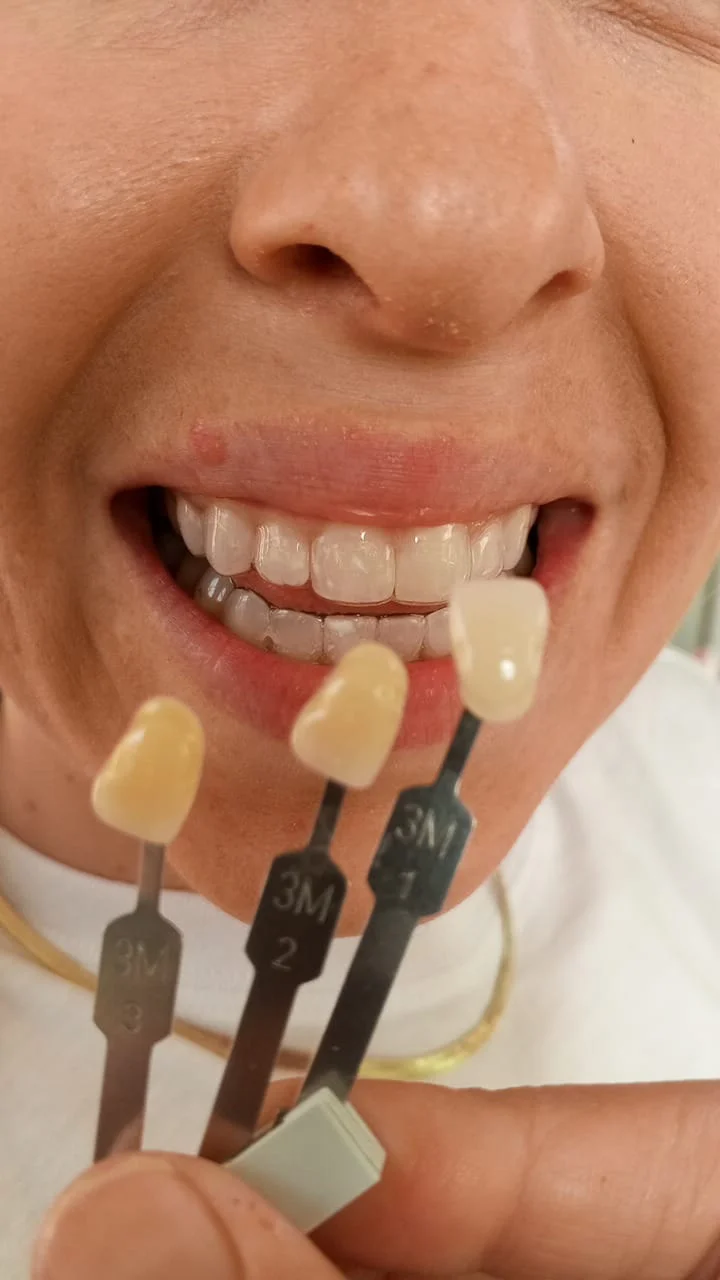 Teeth whitening before and after result